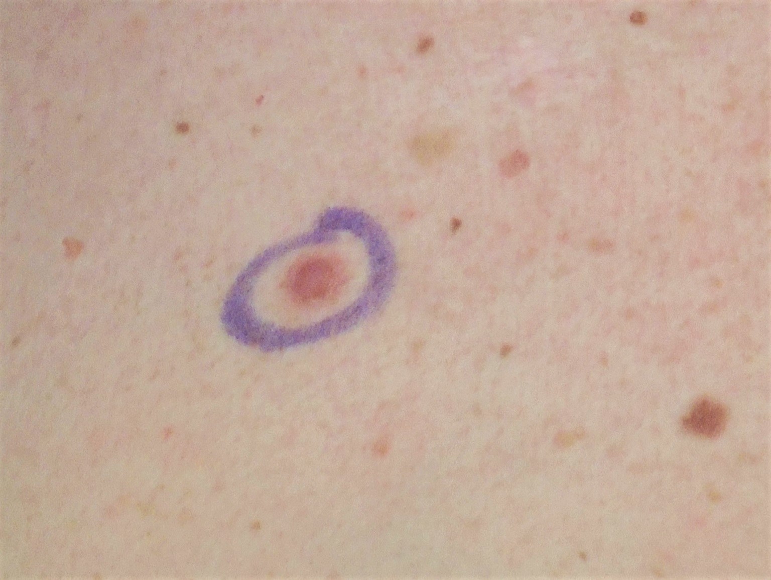 cancerous moles early signs