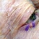 R-lower-eyelid-BCC-845x321