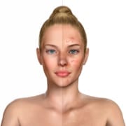 3d illustration of a woman before and after acne treatment proce