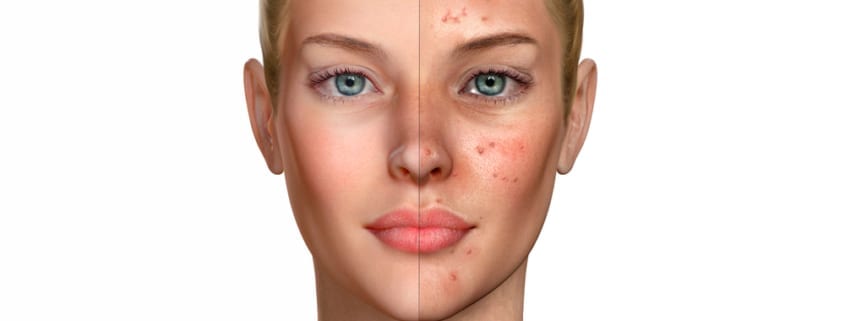 3d illustration of a woman before and after acne treatment proce